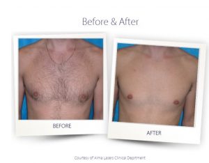 Before and After Laser Hair Removal On Chest
