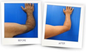 Laser Hair Removal on Arms
