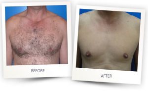 Chest Laser Hair Removal North Hollywood