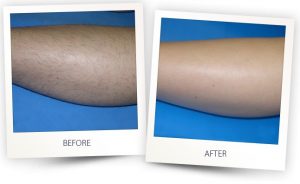Laser Hair Removal on Legs