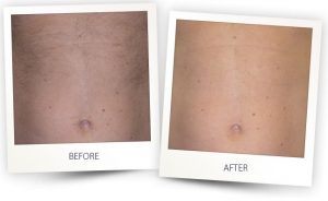 Laser Hair Removal On Stomach