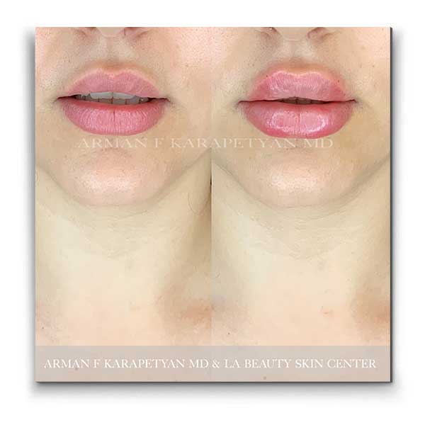 Temporary Lip | Get Fuller Lips | LA Beauty Center