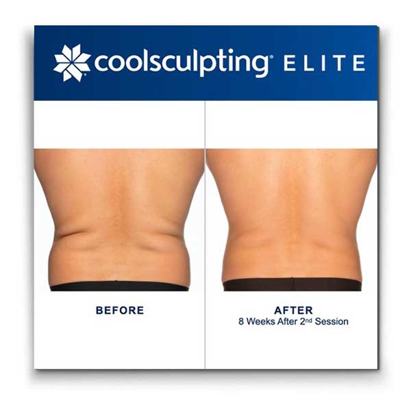 Coolsculpting-back-fat