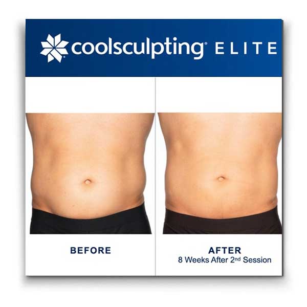 Coolsculpting-elite-mens-stomach