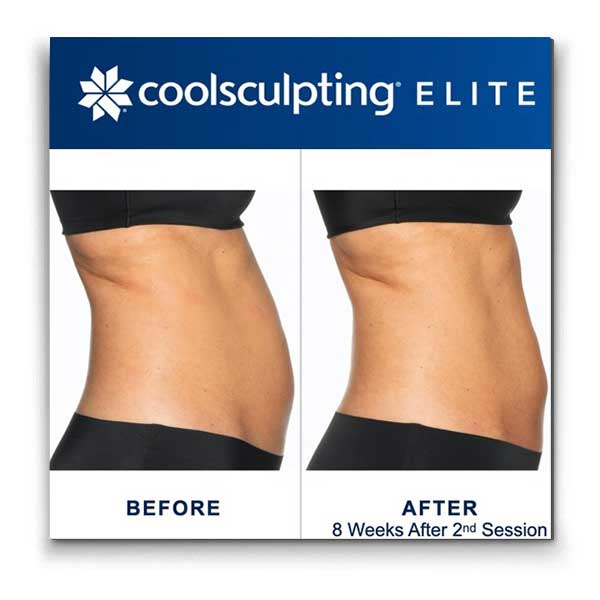 Coolsculpting-elite-stomach