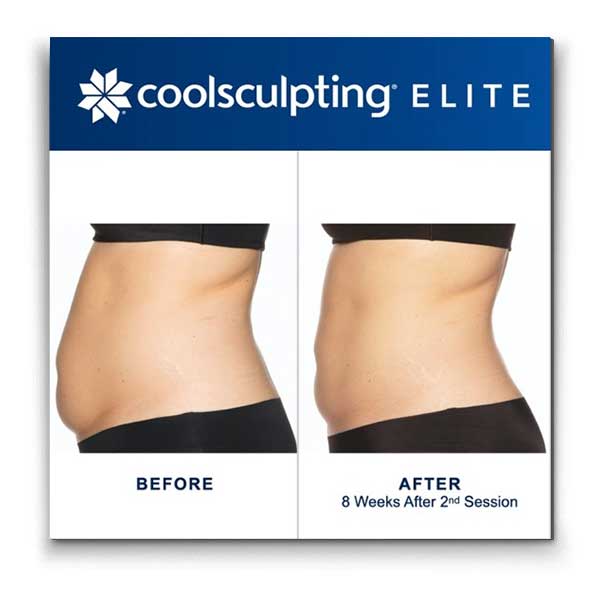 Coolsculpting-elite-tummy