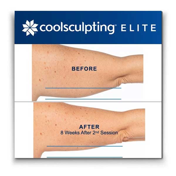 Coolsculpting-under-arms