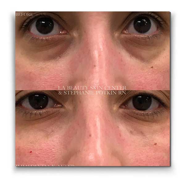 under-eye-injectables