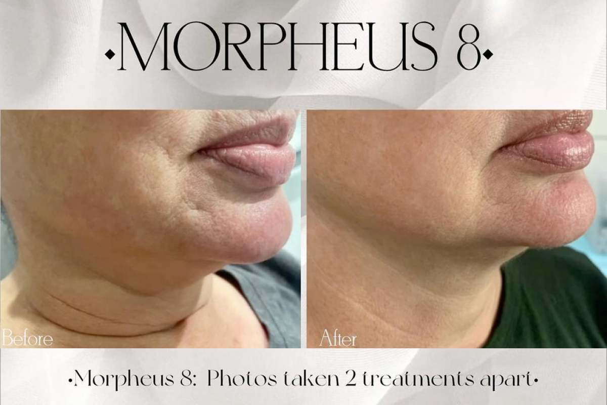 morpheus 8 before and after