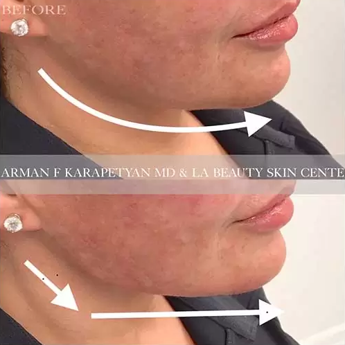 Jaw line shaping - LA Beauty Skin Center