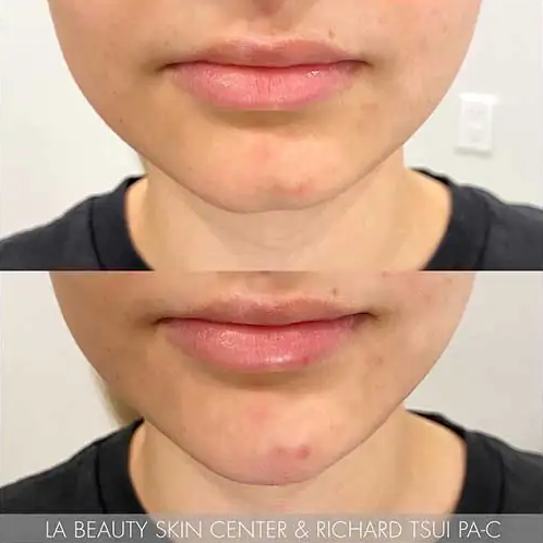 Jaw line shaping - LA Beauty Skin Center