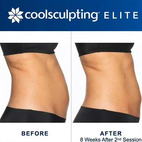 CoolSculpting Elite Before and After Pictures