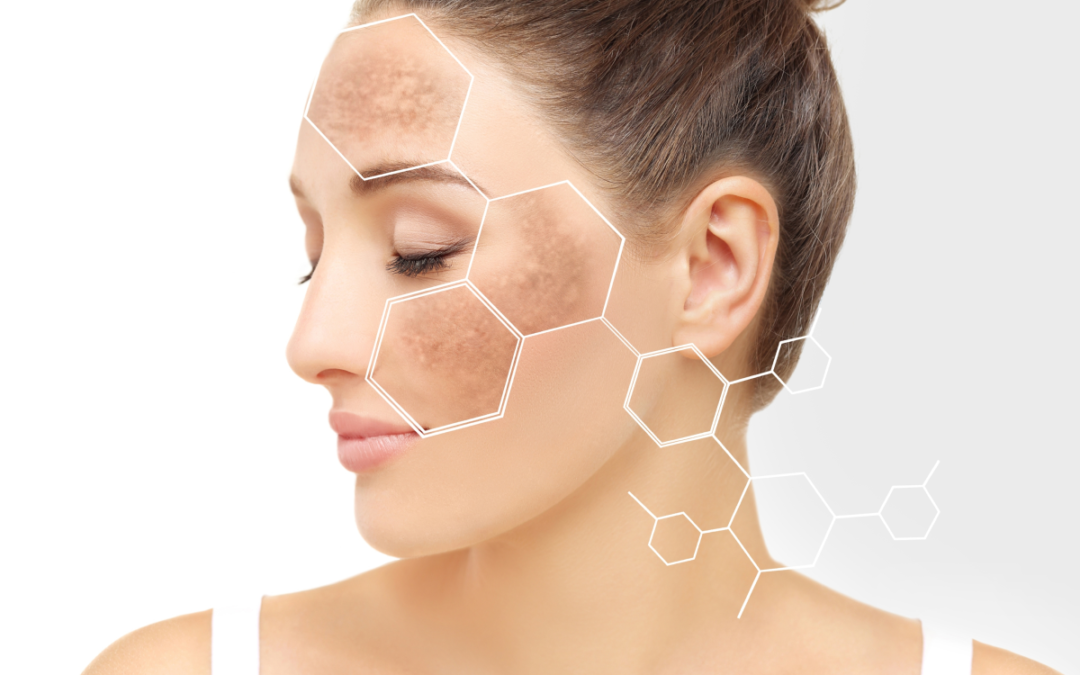 How PicoSure Pro Treatment Can Enhance Skin Texture, Complexion