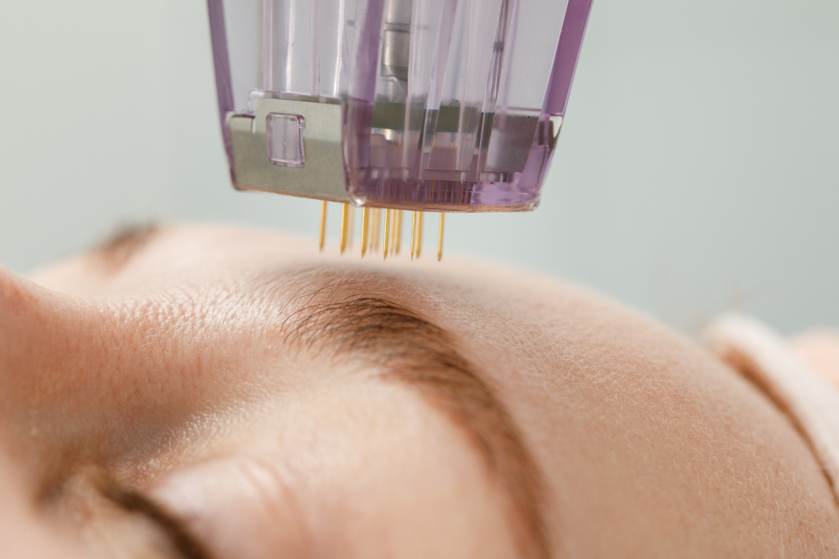 What Are the Benefits of Morpheus8 vs Microneedling