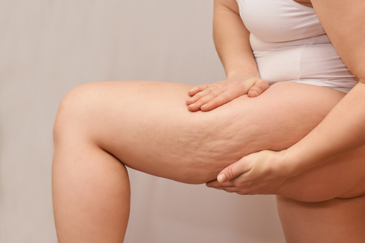 What Causes Cellulite