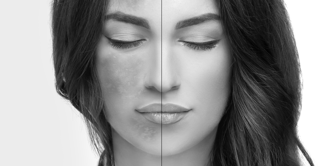 Skin Hyperpigmentation Types, Causes and Treatment